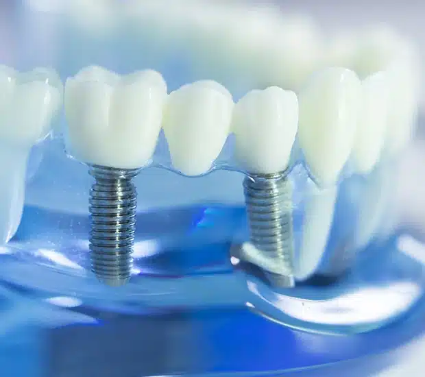 علاج فشل زراعة الأسنان