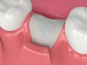 كيف اعرف فشل زراعة الأسنان