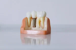 فوائد زراعة الأسنان