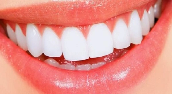أنواع فينير الأسنان