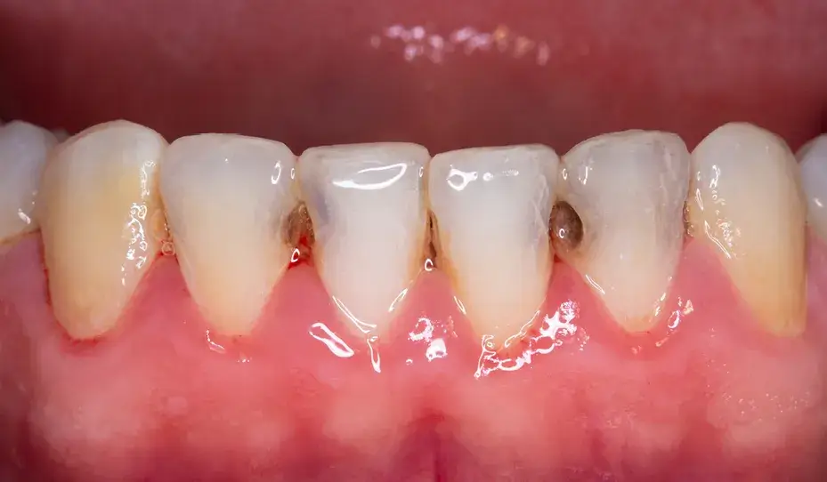 تسوس الأسنان الأمامية السفلية