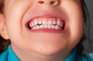 الجز على الأسنان أثناء النوم عند الأطفال