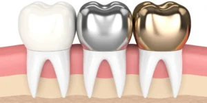 أنواع بورسلين الأسنان