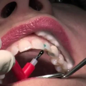 بداية تسوس الأسنان الامامية