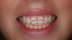 سبب ظهور بقع بيضاء في الأسنان