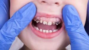 طريقة خلع الأسنان اللبنية للاطفال