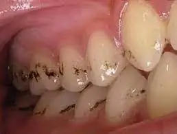 ظهور خطوط سوداء على الأسنان